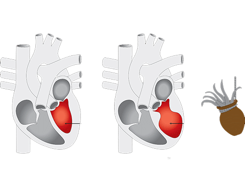 El síndrome de Takotsubo. Entre el corazón roto y el corazón feliz