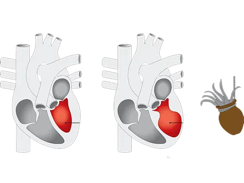 El síndrome de Takotsubo. Entre el corazón roto y el corazón feliz